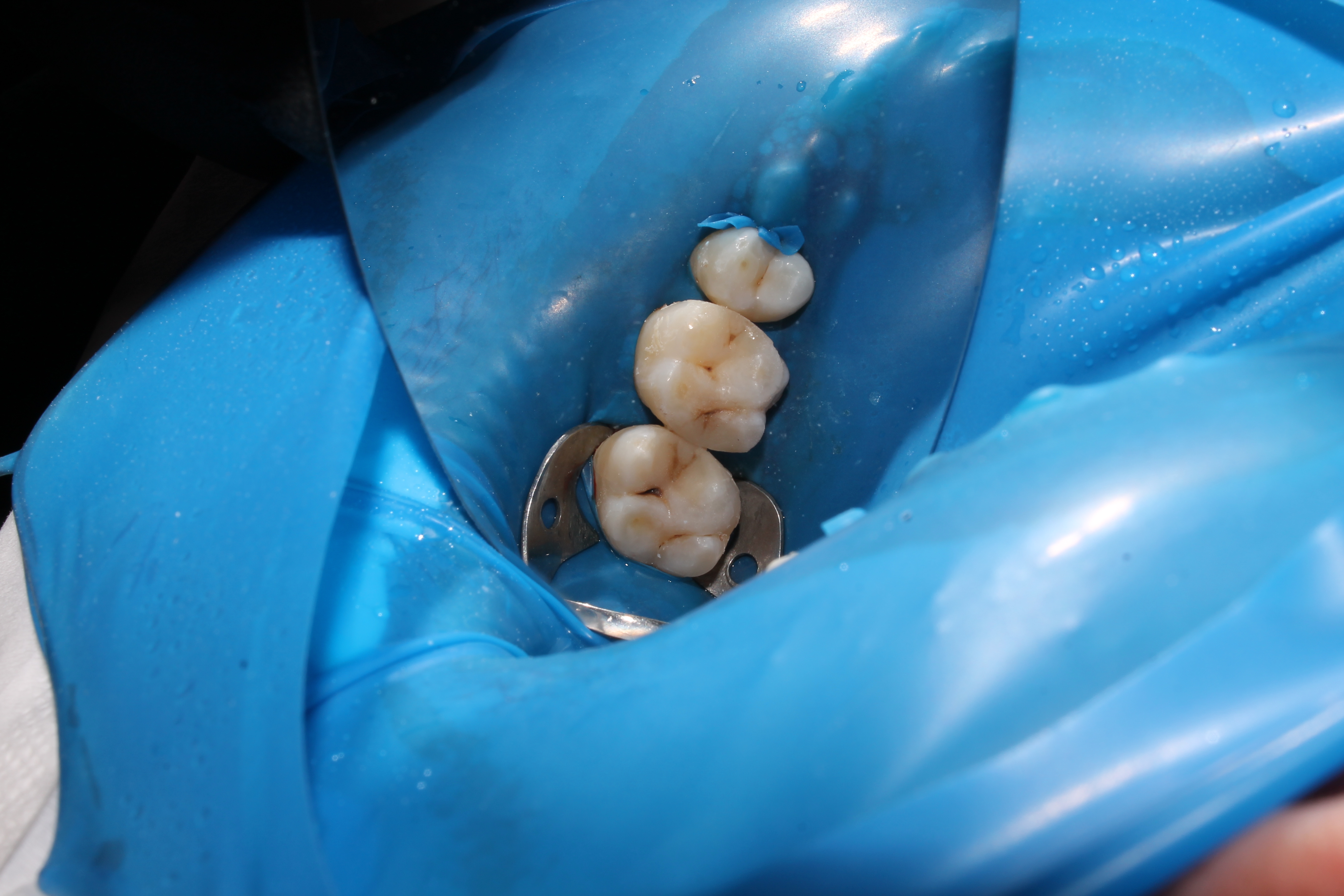 Rubber Dam Uygulaması